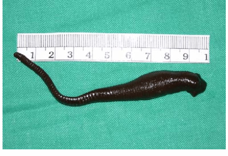 We-completely-removed-the-nasal-leech-The-length-of-nasal-leech-without-full-extension